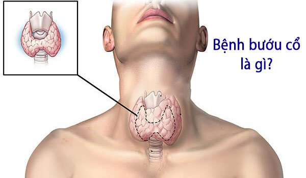 benh-buou-co-la-gi