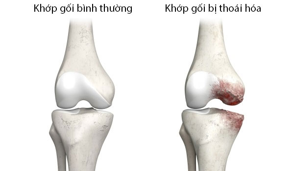 Thoái hoá khớp gối là gì?