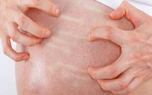 Dị ứng thức ăn Bệnh thường gặp, chủ quan là nguy