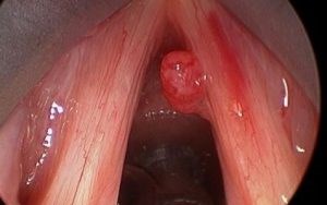 LAO THANH QUẢN BIẾN CHỨNG NGUY HIỂM