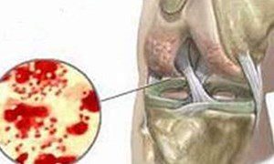VIÊM KHỚP NHIỄM KHUẨN BIẾN CHỨNG NGUY HIỂM NHƯ NÀO?
