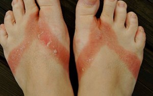 BỆNH VIÊM DÃ TIẾP XÚC DỊ ỨNG CĂN BỆNH DỄ MẮC, KHÓ CHỮA