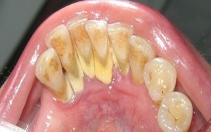 VIÊM LỢI LIÊN QUAN ĐẾN MẢNG BÁM RĂNG CÁCH ĐIỀU TRỊ DỨT ĐIỂM