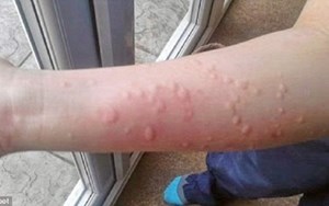 BỆNH MÀY ĐAY KHÔNG HẲN LÀ MỘT CĂN BỆNH LÀNH TÍNH