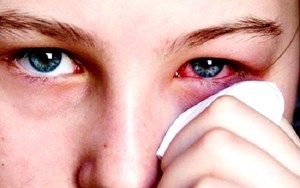 Bệnh viêm kết mạc mùa xuân Những điều cần biết trong phòng và điều trị
