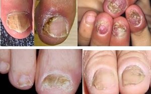 TÌM HIỂU VỀ BỆNH NẤM MÓNG VÀ PHƯƠNG THỨC CHỮA TRỊ