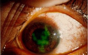 Viêm loét giác mạc do nấm có thể bị mù