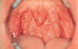 VIÊM HỌNG CẤP TÍNH CHỮA TRỊ SỚM KHỎI BIẾN CHỨNG