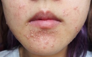 BỆNH TRỨNG CÁ DẤU HIỆU TRIỆU CHỨNG, CHẨN ĐOÁN DA LIỄU