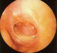 VIÊM TAI GIỮA MÃN TÍNH NGUYÊN NHÂN VÀ BIẾN CHỨNG