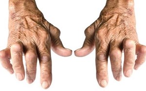CÁC TIÊU CHUẨN ĐÁNH GIÁ MỨC ĐỘ HOẠT ĐỘNG CỦA BỆNH VIÊM KHỚP DẠNG THẤP