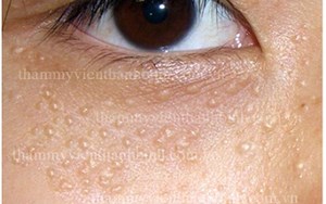 U ỐNG TUYẾN MỒ HÔI CHẨN ĐOÁN SỚM VÀ ĐIỀU TRỊ HIỆU QUẢ