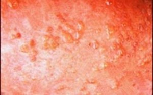 VIÊM DA DẠNG HERPES CỦA DUHRING-BROCQ DẤU HIỆU NHẬN BIẾT VÀ CÁCH CHỮA TRỊ