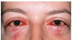 Viêm kết mạc cấp Dấu hiệu triệu chứng, nguyên nhân và chẩn đoán điều trị