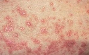 BỆNH LICHEN PHẲNG VÀ NHỮNG ĐIỀU CẦN BIẾT