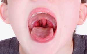 VIÊM V.A CẤP VÀ MÃN TÍNH GÂY ẢNH HƯỞNG KHÔNG NHỎ ĐẾN SỨC KHỎE