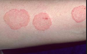 NẤM DA ((DERMATOPHYTOSIS) VÀ CÁC BIỆN PHÁP ĐIỀU TRỊ BỆNH NẤM DA