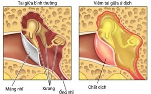VIÊM TAI Ứ DỊCH Ở TRẺ EM CHA MẸ CẦN BIẾT!