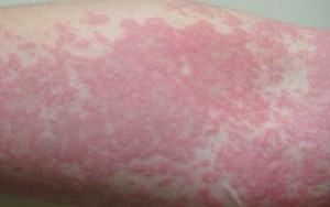 CÁC DẠNG BỆNH LUPUS BAN ĐỎ VÀ CÁCH ĐIỀU TRỊ HIỆU QUẢ