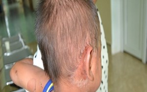 HỘI CHỨNG BONG VẢY DA DO TỤ CẦU