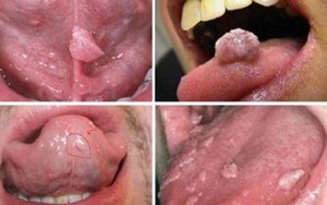 MẮC SÙI MÀO GÀ Ở MIỆNG CÓ ĐIỀU TRỊ ĐƯỢC KHÔNG ?