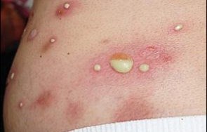 BỆNH CHỐC TRIỆU CHỨNG, NGUYÊN NHÂN VÀ CÁCH ĐIỀU TRỊ