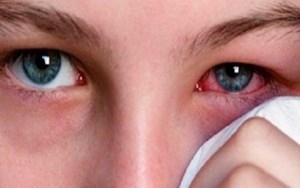 Bệnh viêm kết mạc dị ứng và cách điều trị