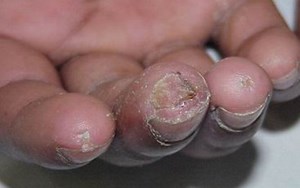 BỆNH MÔ LIÊN KẾT HỖN HỢP CHẨN ĐOÁN VÀ ĐIỀU TRỊ