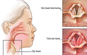 VIÊM THANH QUẢN MÃN TÍNH NGUY HIỂM NHƯ NÀO?