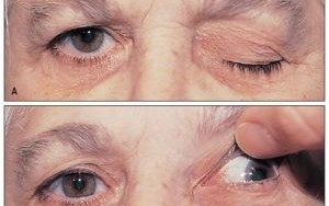 Liệt vận nhãn Nguyên nhân, triệu chứng và điều trị bệnh