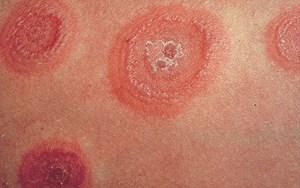 HỒNG BAN ĐA DẠNG TRIỆU CHỨNG, NGUYÊN NHÂN VÀ CÁCH PHÒNG TRỊ