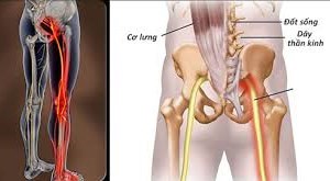 ĐAU THẦN KINH TỌA CĂN BỆNH GÂY ẢNH HƯỞNG NHIỀU ĐẾN SỨC KHỎE