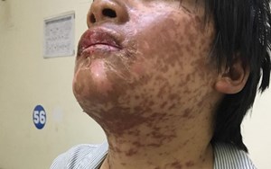 DỊ ỨNG THUỐC NHIỀU NGUY HIỂM CHẾT NGƯỜI