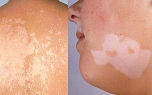 LANG BEN CĂN BỆNH PHỔ BIẾN Ở VÙNG NHIỆT ĐỚI