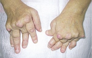 BỆNH VIÊM KHỚP THIẾU NIÊN TỰ PHÁT THỂ HỆ THỐNG BIẾN CHỨNG NẶNG NỀ KHÔNG ĐƯỢC CHỦ QUAN