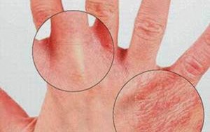 Viêm da cơ địa Nỗi ám ảnh của người bệnh