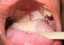 BỆNH DA VÀ NIÊM MẠC DO CADIDA CHẨN ĐOÁN VÀ ĐIỀU TRỊ