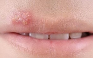 BỆNH HERPES SINH DỤC TÌM HIỂU SỚM, PHÒNG NGỪA KỊP