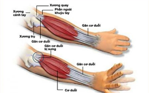 CHẨN ĐOÁN VÀ ĐIỀU TRỊ VIÊM LỒI CẦU SỚM GẶP BÁC SĨ KẺO HỐI HẬN MUỘN MÀNG