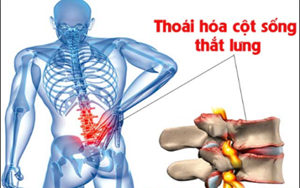 BỆNH THOÁI HÓA CỘT SỐNG THẮT LƯNG CẢNH BÁO NGUY CƠ TÀN PHẾ NẶNG