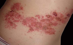 VIÊM DA DO TIẾP XÚC CÔN TRÙNG XỬ LÝ VÀ CÁCH PHÒNG TRÁNH