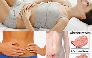 U XƠ TỬ CUNG BIẾN CHỨNG NGUY HIỂM NHƯ NÀO?