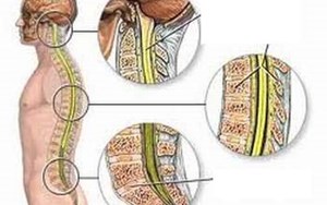 VIÊM XƯƠNG TỦY NHIỄM KHUẨN BỆNH LÝ GÂY ẢNH HƯỞNG SỨC KHỎE NẶNG NỀ
