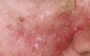 VIÊM DA DẦU CÁCH NHẬN BIẾT VÀ PHÒNG TRÁNH BỆNH