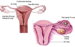 MANG THAI NGOÀI TỬ CUNG NGUY HIỂM MẤT CẢ CON LẪN MẸ, ĐỪNG XEM THƯỜNG