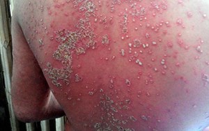 BỆNH VẢY NẾN HƯỚNG DẪN ĐIỀU TRỊ