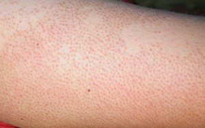 BỆNH VIÊM NANG LÔNG LÀ GÌ? TRIỆU CHỨNG VÀ CÁCH CHỮA TRỊ