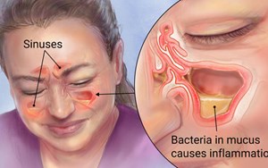 VIÊM MŨI XOANG MẠN TÍNH GÂY CỨNG CỔ, ĐAU ĐẦU NGHIÊM TRỌNG ĐỪNG XEM THƯỜNG