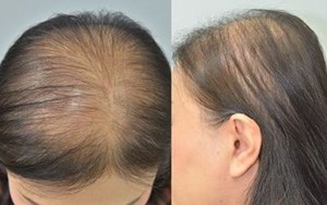 BỆNH RỤNG TÓC VÀ CÁCH ĐIỀU TRỊ HIỆU QUẢ