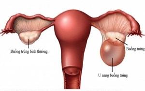 U NANG BUỒNG TRỨNG NGUY HIỂM ĐẾN MỨC ĐỘ NÀO?
